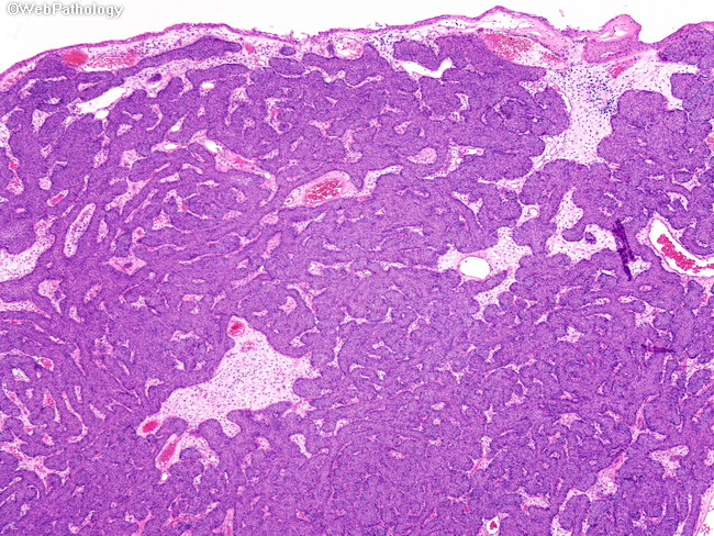 bladder inverted papilloma pathology ano con papiloma