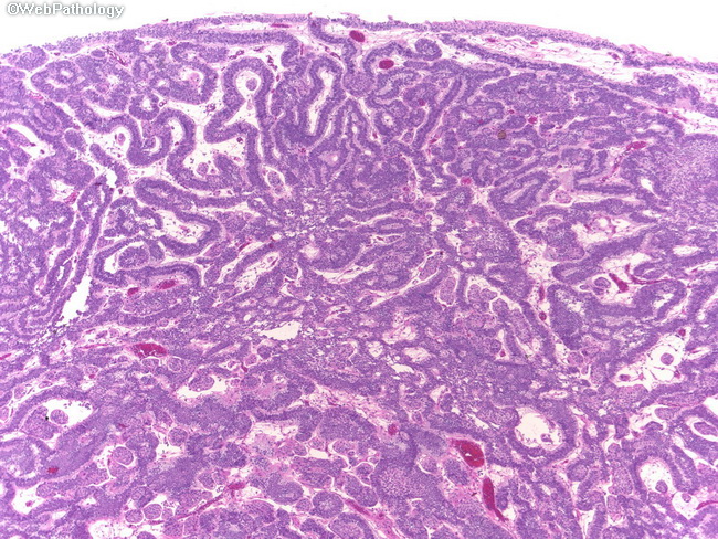 inverted papilloma of bladder pathology