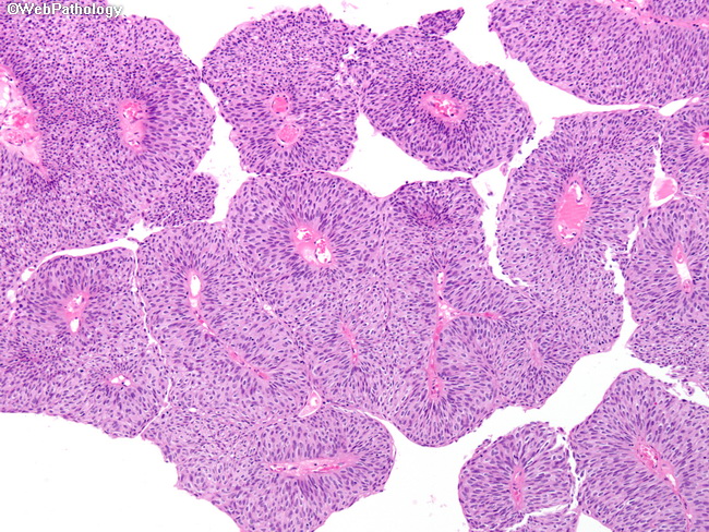 A papillary urothelial neoplasm