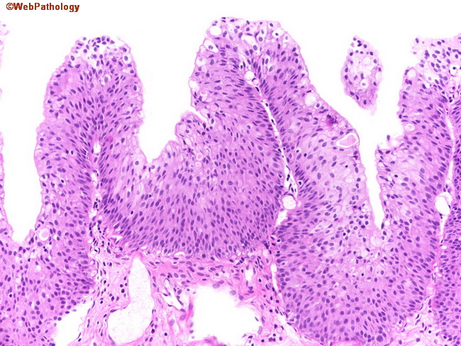 atypical papillary urothelial hyperplasia