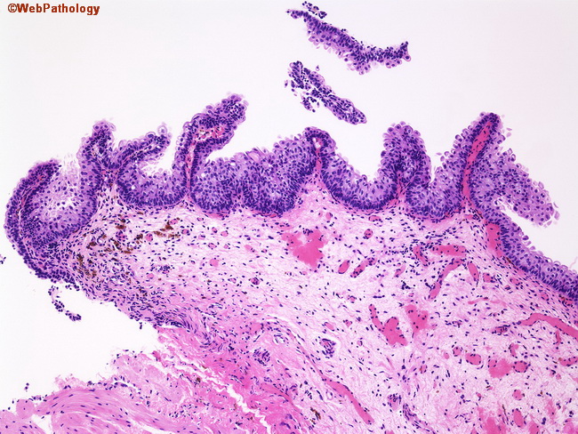 papillary urothelial hyperplasia histology