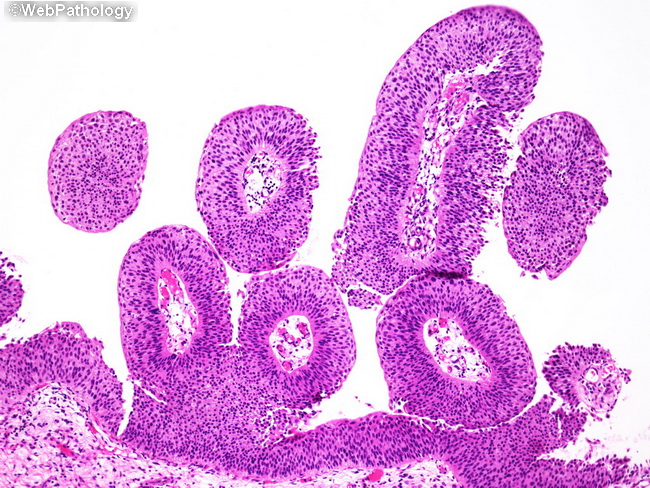 Papillary urothelial lesion of low malignant potential - Papillary urothelial malignant