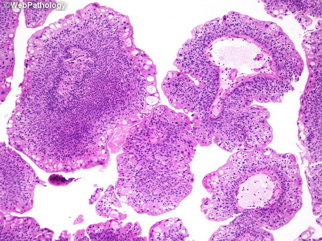Bladder papilloma pathology