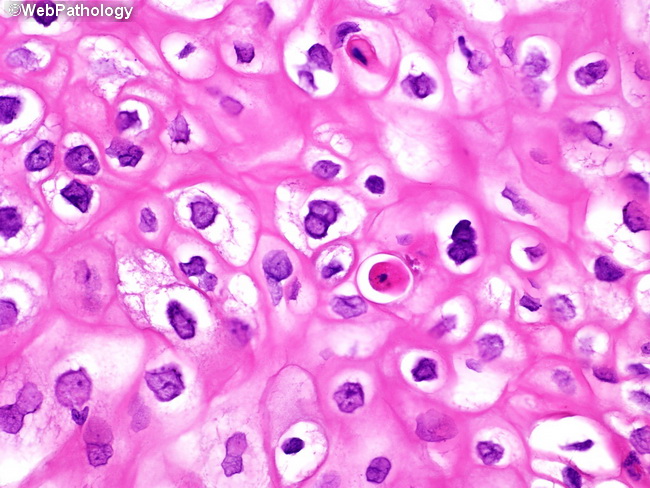 urethral condyloma pathology)