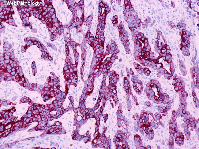 UrinaryBladder_Variants_Carcinosarcoma10_CK.jpg