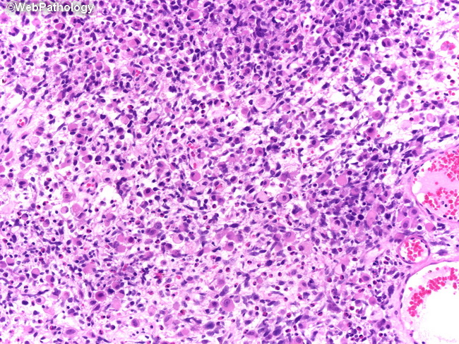UrinaryBladder_Variants_Carcinosarcoma3_RMS.jpg