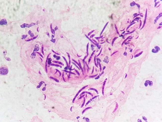 UrineCytology_Fusarium1_resized.jpg