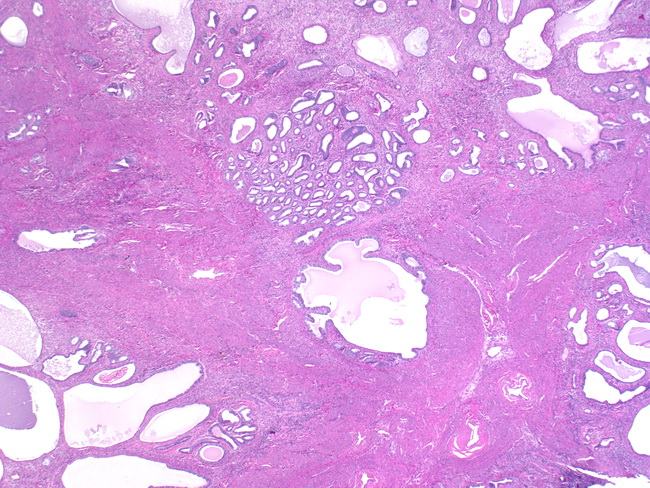Uterus_AtypicalPolypoidAdenomyoma1.jpg