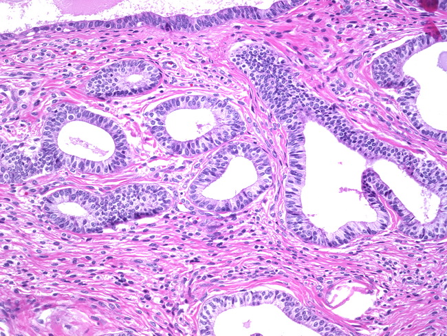 Uterus_AtypicalPolypoidAdenomyoma2.jpg
