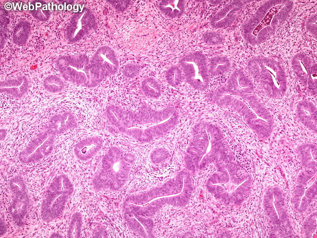 Uterus_AtypicalPolypoidAdenomyoma4.jpg