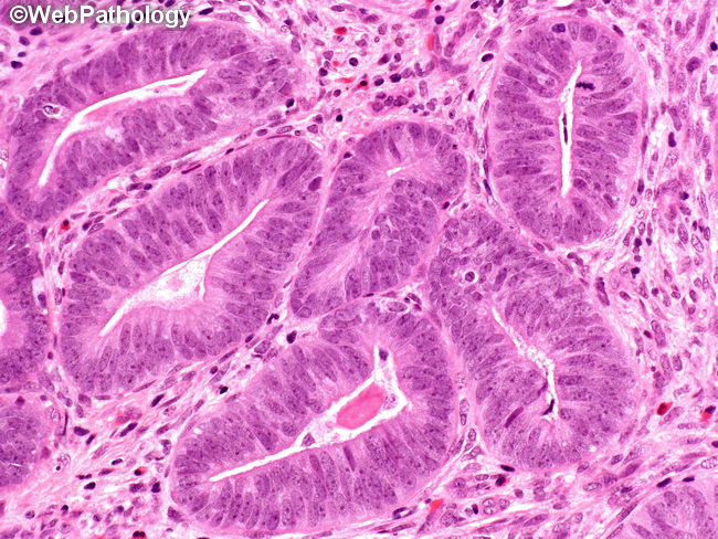 Uterus_AtypicalPolypoidAdenomyoma6.jpg