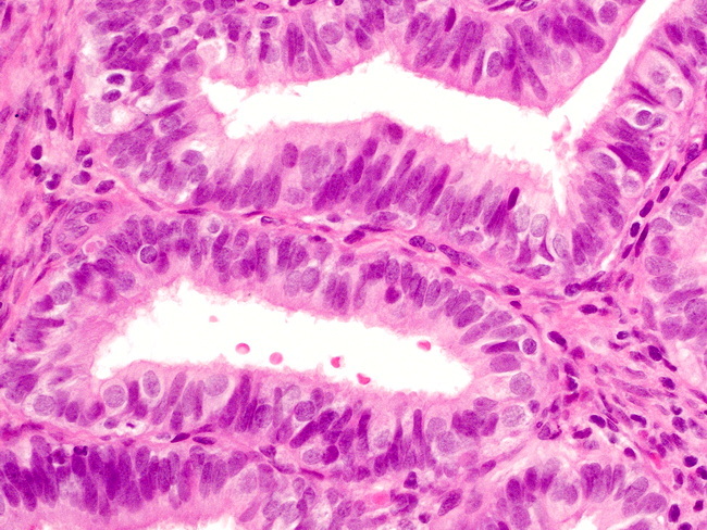 Uterus_EndometrialHyperplasia_NEH12_TubalMetaplasia.jpg