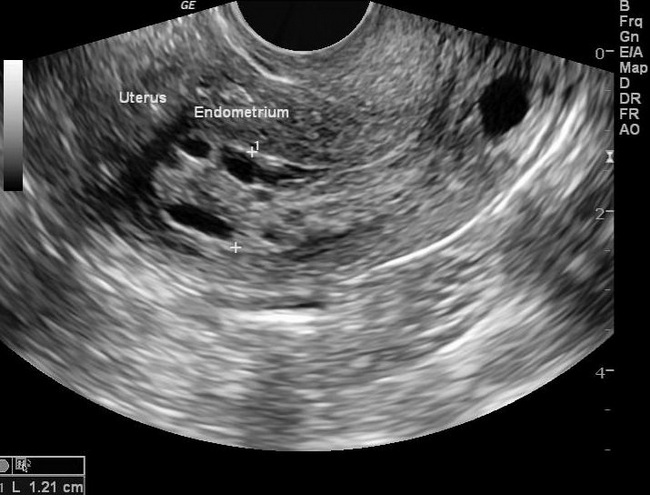 Uterus_EndometrialHyperplasia_US_resized.jpg