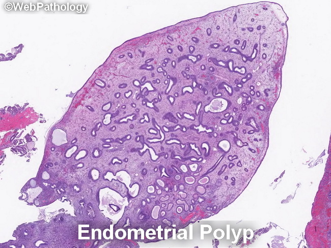 Uterus_EndometrialPolyp1_resized(1).jpg
