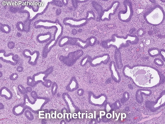 Uterus_EndometrialPolyp2_resized(1).jpg