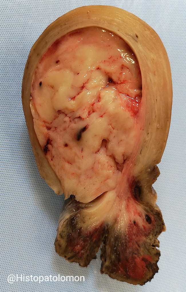 Uterus_EndometrialStromalSarcoma_Gross1_resized.jpg