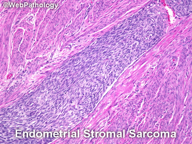 Uterus_EndometrialStromalSarcoma_VascularInvasion1.jpg