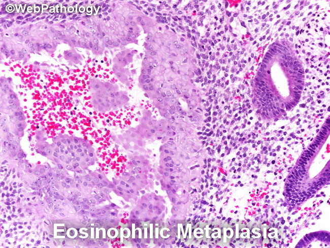 Uterus_Endometrium_EosinophilicMetaplasiaA(1).jpg