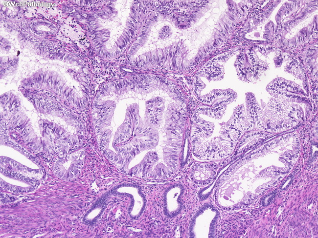 Uterus_Endometrium_MucinousMetaplasia1.jpg
