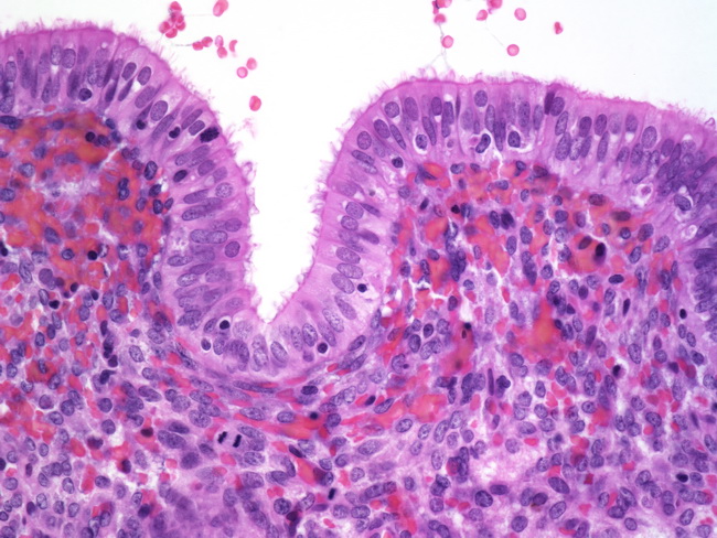 Uterus_Endometrium_TubalMetaplasia.jpg