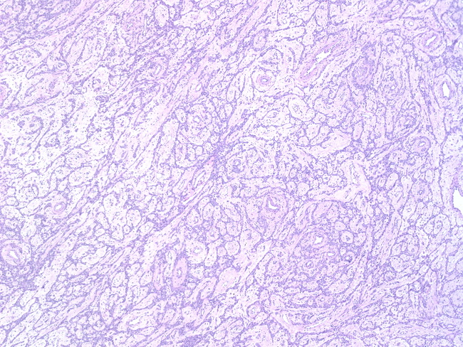 Uterus_EpithelioidLeiomyoma_Plexiform1.jpg