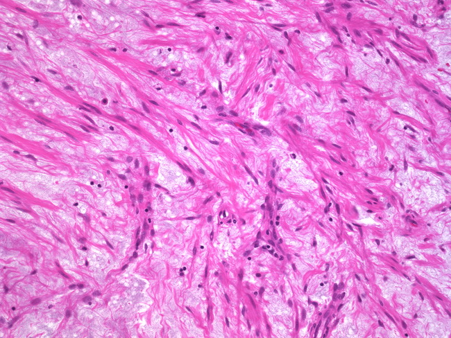Uterus_Leiomyoma10_Myxoid.jpg