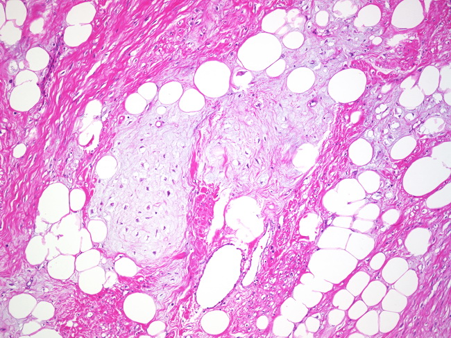 Uterus_Lipoleiomyoma4_ChondroidMetaplasia.jpg