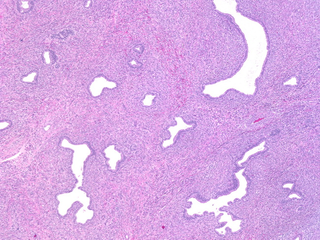 Uterus_MullerianAdenosarcoma1.jpg