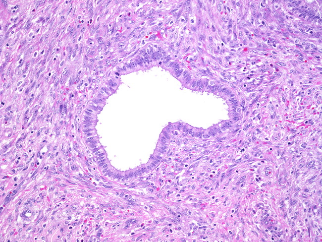 Uterus_MullerianAdenosarcoma2.jpg