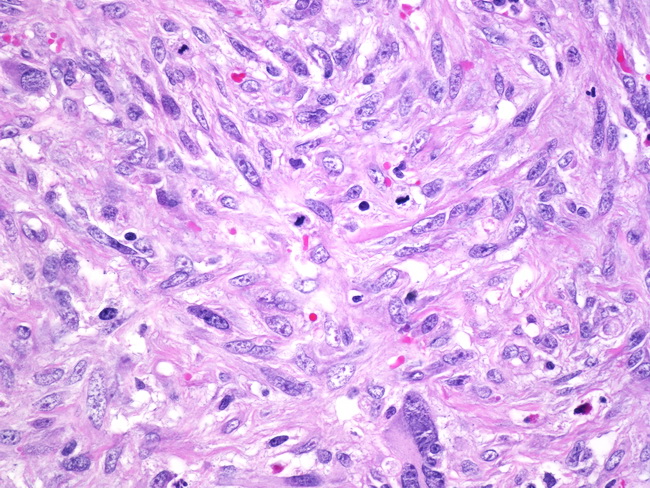 Uterus_MullerianAdenosarcoma3.jpg