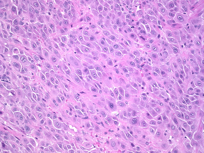 Uterus_PlacentalSiteTrophoblasticTumor1.jpg