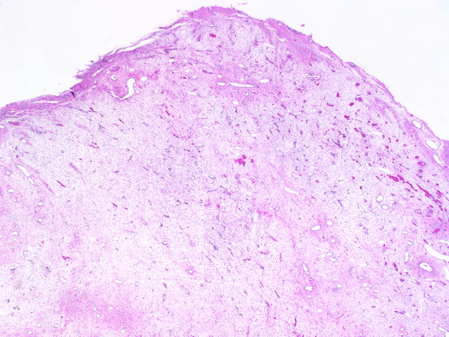 what is fibroepithelial papilloma
