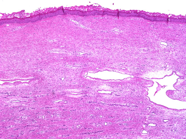 fibroepithelial papilloma