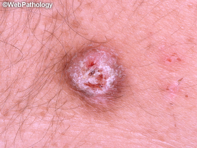 common warts hpv type)