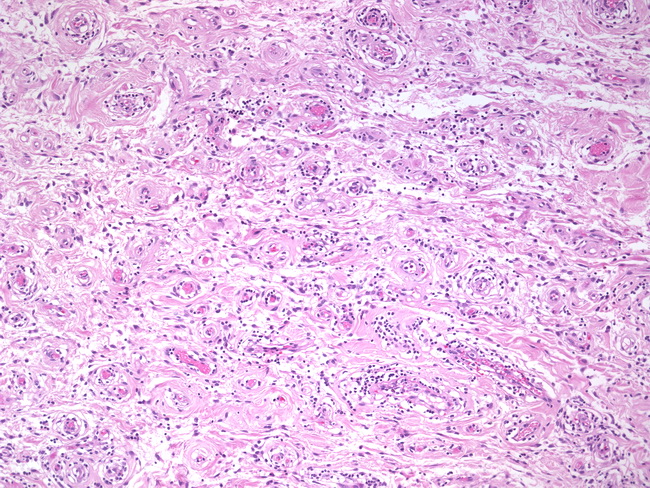 Vulva_Angiofibroblastoma1.jpg