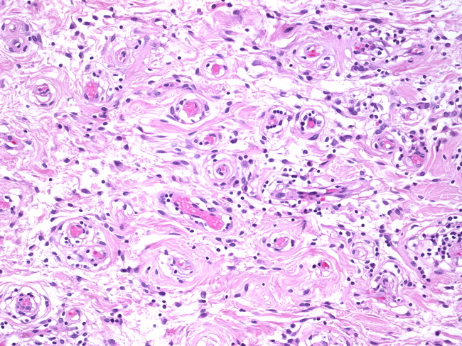 Vulva_Angiofibroblastoma2.jpg