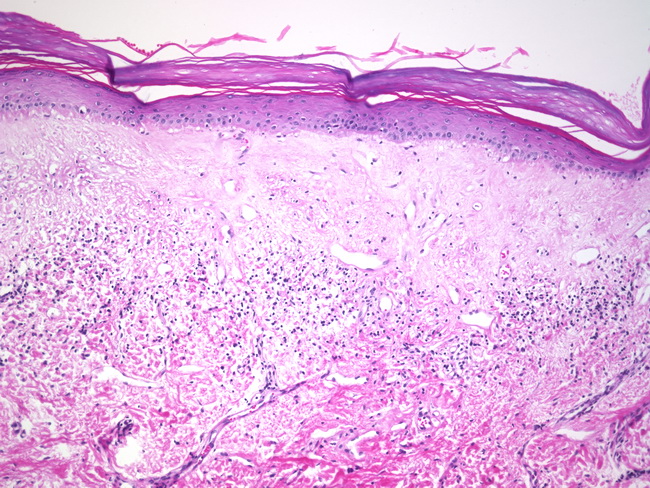 Vulva lichen sclerosus Vulvar Lichen